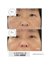 レア(Rea)/シミケアコース