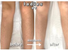 キュー(cue)/【レディース】「膝下脱毛」