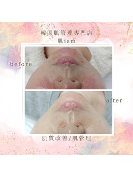 肌イズム つくば店(肌ism)/【before＆after】ニキビケア