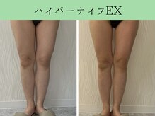 ソルニス(Solnis.)/痩身☆脂肪分解/ハイパーナイフ