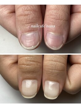 ネイルカフェ ナナ(nailcafe'nana)/自爪育成矯正
