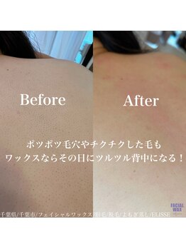 エリス(ELISSE)/ウェディングに背中ワックス