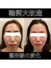【10名限定モニター】エラ張り/面長/歪み◇小顔矯正×美容鍼¥110550→¥33000