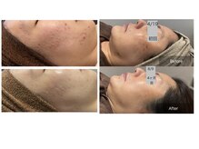 ニキビやシミ、あらゆる長年の悩みを根本から解決♪