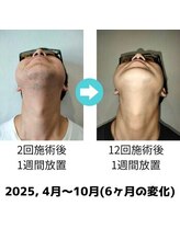 アウリンコ(Aurinko)/ヒゲ脱毛