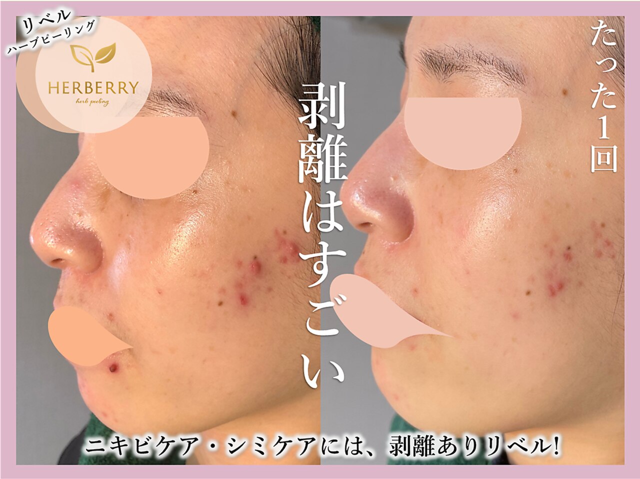 ハーブピーリング専門店HERBERRYハーブピーリング栄(リベル/REVI
