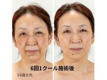 人気No.1ヒト臍帯血細胞培養液65%エステで、小顔＆肌質改善！