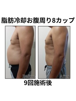 ホワイトビューティーラボ(White Beauty Lab)/【痩身】腹部８カップ９回施術後