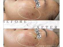 ベベ 表参道(bebe)/肌トラブルにお悩みの方へ