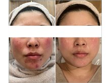 アンク(Ankh)/肌改善はここからスタート