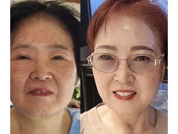 ICDスキンスタジオ 新宿三丁目(ICD-skin studio)/Before-After