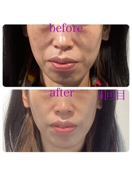 ルシアス(LUCIAS)/小顔矯正