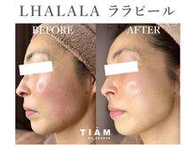 ティアム バイ テトテ 神戸三宮(TIAM by tetote)/ LHALALA ララピール 