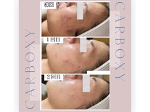 アリー(ALLY)/CARBOXY 炭酸パック