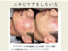 BUB 立川/繰り返すニキビケア綺麗にしたい