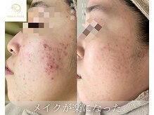 ベルフィーヌ 目黒店(BELFINE)/ハーブピーリング