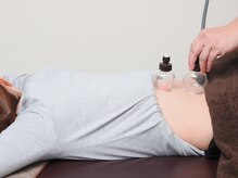 トラスト整骨院鍼灸院/カッピングで血行促進！腰痛改善