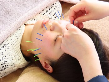 ケアラボ(Care Labo)の写真/盛岡で本格美容鍼をうけるなら！お一人お一人に合わせた施術◎体の鍼もあり◎肩こりにも◎美容鍼¥5500～