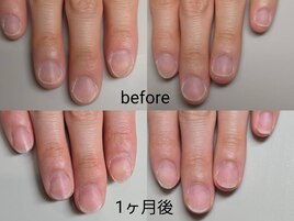 深爪矯正1ヶ月