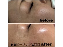 艶玉フェイシャル《ニキビケア.毛穴改善.シミケア.くすみケア》