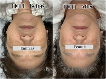 エミマス ボーテ(Emimas Beaute’)/５０代　毛穴洗浄＆幹細胞