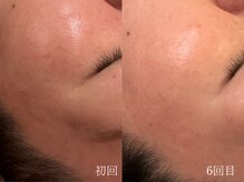 ウォーム(warm)/肌質改善/岡山/フェイシャル