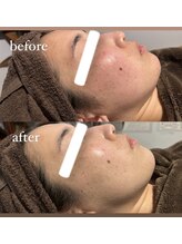 カシェット(cachette)/炭酸ガスパック×ウルトラ