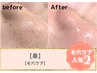 1回で半分以上の鼻の黒ずみ、詰まり除去★毛穴ケア★通常¥7700