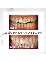 ホワイトニング ビューティー 南魚沼店(whitening beauty)/お試しナチュラルホワイトニング