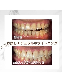ホワイトニング ビューティー 南魚沼店(whitening beauty)/お試しナチュラルホワイトニング