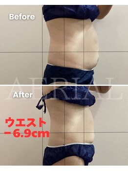 エアリアル 武雄店/脂肪冷却ビフォーアフター