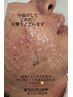 メンズ【ヒゲ脱毛】お肌を美肌に導くクレンジング付　驚愕の効果を実感
