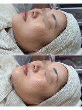 ソワナ(soina)/【神楽坂駅/フェイシャル/毛穴】