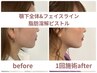 【正面&横顔スッキリ】顎下&フェイスライン/小顔脂肪分解ピストル ¥38,5000→