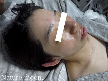 ナチュールムーン(Nature moon.)/ハーブピーリング　after