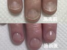 初回でこの変化！深爪・自爪育成
