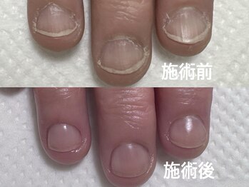 アメジスト(Amethyst)/初回でこの変化!深爪・自爪育成