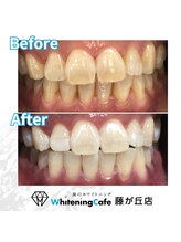 ホワイトニングカフェ 藤が丘店(WhiteningCafe)/ホワイトニングビフォーアフター