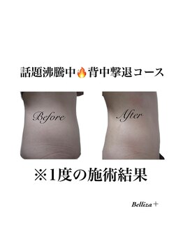 ベリーザプラス(Belliza+)/当店自慢の背中撃退コース