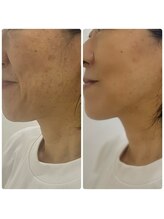 リミューズ マロアマーノ(Re.MUSE MAROaMano)/ララピール５回目LHALALAピール