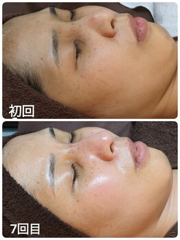 ウララ(ulala)/ピーリング7回目