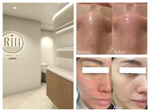 リィ プラス(Riii plus)の雰囲気（お肌管理やDT軽減にもおすすめ◎LDM＋LED通い放題が大人気！）