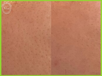 ハーブピーリング 名古屋/1回の変化♪　毛穴に注目(^_^)/