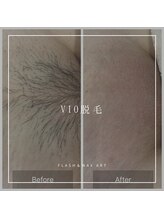 アート 熊本並木坂店(ART)/vio脱毛