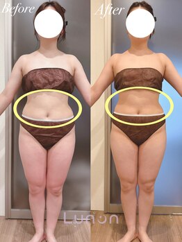 ルノン(Lunon)/【ブライダル】ダイエット1回目