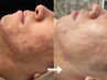 【ニキビ気になる方】美肌顔脱毛体験!毛穴レス/ニキビ/敏感肌/くすみ肌◎