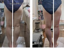 紬(TSUMUGI)/足の左右差解消で腰痛改善