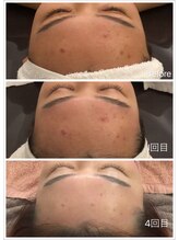 オプレア 千種店(OPREA)/【比較写真】肌質改善