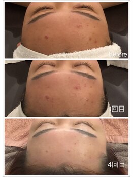 オプレア 千種店(OPREA)/【比較写真】肌質改善