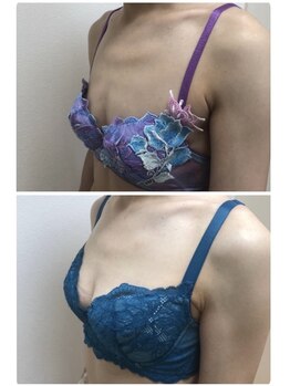 アンドモア(&more)/バストアップ症例